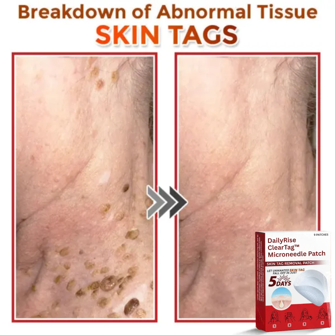 Cvreoz® MicroNeedle Botanic Skin Tag Removal Patch